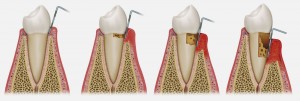 Periodontal Disease